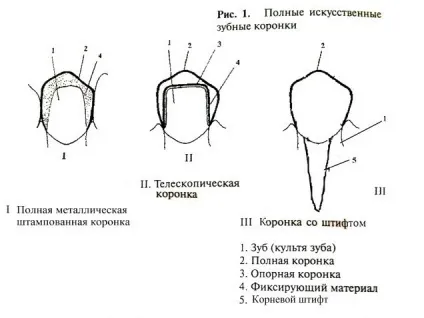 зубні коронки
