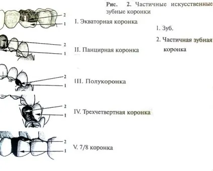зубні коронки