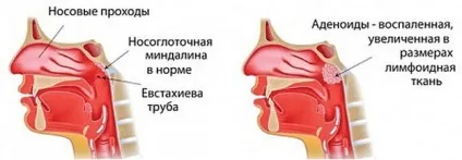 Аденоїди як виглядають в носі