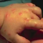 Чим прибрати укуси від комарів у дитини