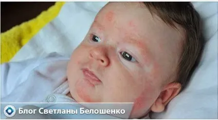 Чим зняти свербіж при алергії у дитини в домашніх умовах (зняти) Чим зняти свербіж при алергії у дитини в домашніх умовах