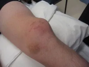 Що робити при вивиху колінного суглоба симптоми, лікування в домашніх і стаціонарних умовах (вивих колінного суглоба) Що робити при вивиху колінного суглоба симптоми, лікування в домашніх і стаціонарних умовах