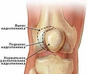 Що робити при вивиху колінного суглоба симптоми, лікування в домашніх і стаціонарних умовах (суглоба) Що робити при вивиху колінного суглоба симптоми, лікування в домашніх і стаціонарних умовах