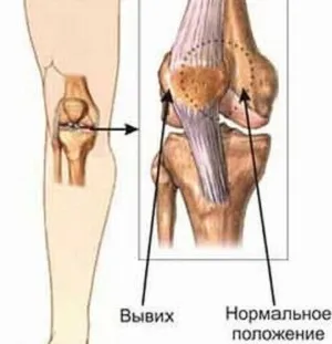 Що робити при вивиху колінного суглоба симптоми, лікування в домашніх і стаціонарних умовах (вивих колінного суглоба) Що робити при вивиху колінного суглоба симптоми, лікування в домашніх і стаціонарних умовах