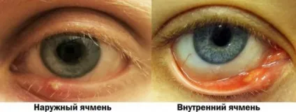 Що робити, якщо з'явився ячмінь на оці лікування в домашніх умовах, замучив, вискочив, вилазить, (оці) Що робити, якщо з'явився ячмінь на оці лікування в домашніх умовах, замучив, вискочив, вилазить,