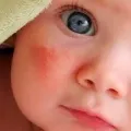 Дієта при кропивниці у дорослих що можна їсти, а що ні (гіпоалергенна дієта кропив'янка дорослий що можна не можна їсти їсти харчування) Дієта при кропивниці у дорослих що можна їсти, а що ні
