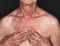 Дерматоміозит - причини, симптоми, діагностика та лікування