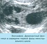 Домінантний фолікул у перші тижні вагітності (правом) Домінантний фолікул у перші тижні вагітності