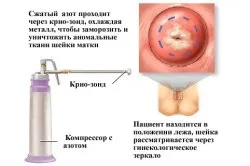 Ектопія шийки матки причини та лікування (ектопія) Ектопія шийки матки причини та лікування