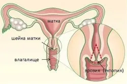 Ектопія шийки матки причини та лікування (матки) Ектопія шийки матки причини та лікування