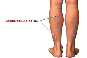 Флебектомія що це таке, хід операції, післяопераційний період, рекомендації (післяопераційний) Флебектомія що це таке, хід операції, післяопераційний період, рекомендації