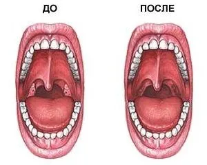 Де знаходяться аденоїди у дитини і як вони виглядають фото (знаходяться) Де знаходяться аденоїди у дитини і як вони виглядають фото