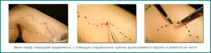 Флебектомія - операція з видалення варикозних вен (варикозних) Флебектомія - операція з видалення варикозних вен