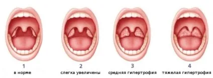 Де знаходяться аденоїди у дитини і як вони виглядають фото (аденоїди) Де знаходяться аденоїди у дитини і як вони виглядають фото
