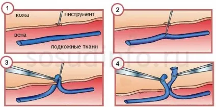 Флебектомія післяопераційний період, реабілітація, ускладнення