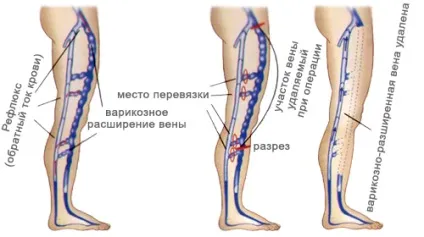 Флебектомія що це таке, хід операції, післяопераційний період, рекомендації (період) Флебектомія що це таке, хід операції, післяопераційний період, рекомендації