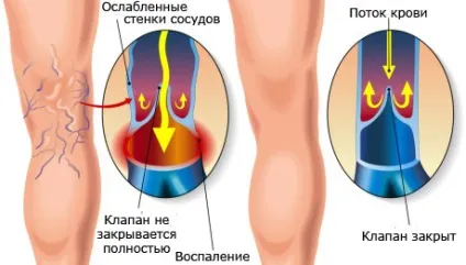 Флебектомія - операція з видалення варикозних вен (флебектомія) Флебектомія - операція з видалення варикозних вен