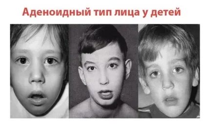 Де знаходяться аденоїди у дитини і як вони виглядають фото (дитини) Де знаходяться аденоїди у дитини і як вони виглядають фото