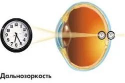 Гіперметропія у дітей