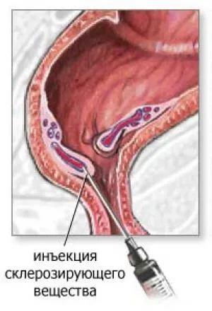 Як швидко вилікувати геморой працюють методи (швидко) Як швидко вилікувати геморой працюють методи