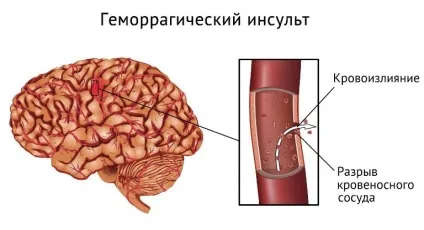 Інсульт та його наслідки життя після «збою» (наслідки) Інсульт та його наслідки життя після «збою»