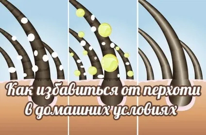 Як швидко і ефективно позбутися від лупи в домашніх умовах (ефективно) Як швидко і ефективно позбутися від лупи в домашніх умовах