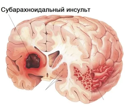 Інсульт та його наслідки життя після «збою» (після) Інсульт та його наслідки життя після «збою»
