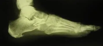 Як лікують п'яткову шпору, центр Дикуля (місця прикріплення ахіллового) Як лікують п'яткову шпору, центр Дикуля