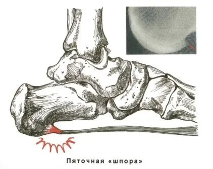 Як лікують п'яткову шпору, центр Дикуля (лікування п'яткової шпори) Як лікують п'яткову шпору, центр Дикуля