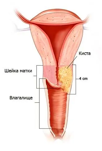 Кісти ендоцервікса на шийці матки ознаки, причини, лікування (шийці) Кісти ендоцервікса на шийці матки ознаки, причини, лікування
