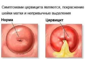Лікування і симптоми запалення цервикального каналу (цервікального) Лікування і симптоми запалення цервикального каналу