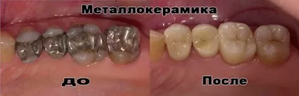 Металокерамічна коронка ціни, передні зуби на фото до і після, відгуки (металокерамічна коронка) Металокерамічна коронка ціни, передні зуби на фото до і після, відгуки