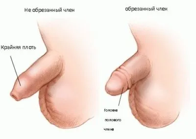 Обрізання у чоловіків або циркумцизия крайньої плоті що це таке, як проводиться чоловіче обрізання (обрізання це) Обрізання у чоловіків або циркумцизия крайньої плоті що це таке, як проводиться чоловіче обрізання