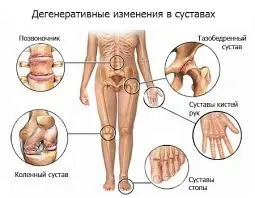 Основні причини больових відчуттів в області суглобів (відчуттів) Основні причини больових відчуттів в області суглобів