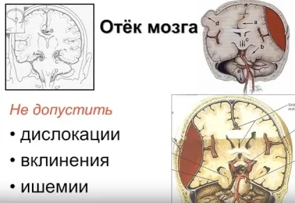 Набряк мозку при інсульті прогноз, симптоми (прогноз) Набряк мозку при інсульті прогноз, симптоми