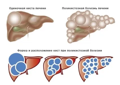 Від кісти печінки і нирок можна позбутися (можна) Від кісти печінки і нирок можна позбутися
