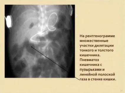 Пневматоз кишечника причини, симптоми і лікування (узі) Пневматоз кишечника причини, симптоми і лікування