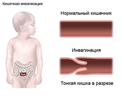 Пневматоз кишечника причини, симптоми і лікування (народні) Пневматоз кишечника причини, симптоми і лікування