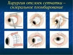 Ознаки відшарування сітківки ока, діагностика, методи лікування (методи) Ознаки відшарування сітківки ока, діагностика, методи лікування