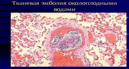 Причини і види емболії