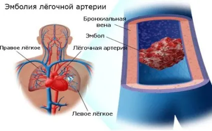 Причини і види емболії
