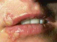 Поширені шкірні захворювання фото і опис з назвами, характер висипань на тілі, руках (висипань) Поширені шкірні захворювання фото і опис з назвами, характер висипань на тілі, руках