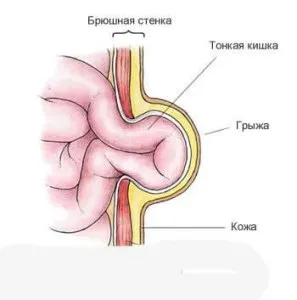 Пупкова грижа у немовляти причини, симптоми, види лікування, профілактика (лікування пупкової грижі) Пупкова грижа у немовляти причини, симптоми, види лікування, профілактика