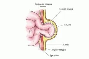 Пупкова грижа у новонароджених - лікування в домашніх умовах бандаж, пластир, масаж (новонароджених) Пупкова грижа у новонароджених - лікування в домашніх умовах бандаж, пластир, масаж