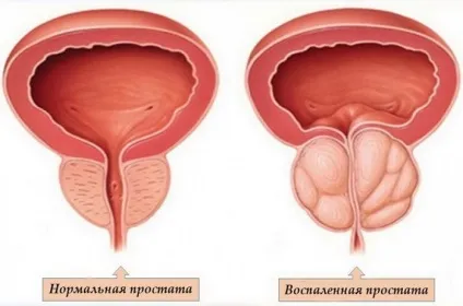 Простатит і алкоголь