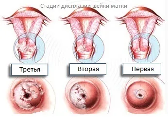 Народити після ерозії шийки матки (шийки) Народити після ерозії шийки матки