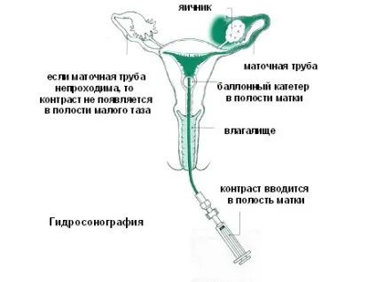 Симптоми і причини утворення спайок після кесаревого розтину