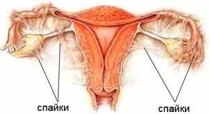 Спайки після кесаревого розтину - симптоми, детальна інформація! (Після) Спайки після кесаревого розтину - симптоми, детальна інформація!