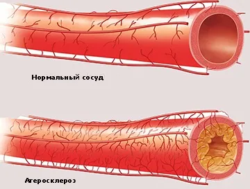 Судинна деменція - стадії і прогноз захворювання