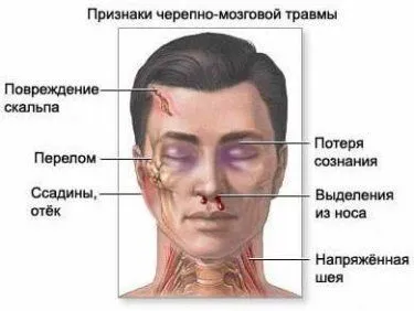 Струс головного мозку симптоми і лікування, перша допомога при струсі, лікування струсу (струсу) Струс головного мозку симптоми і лікування, перша допомога при струсі, лікування струсу